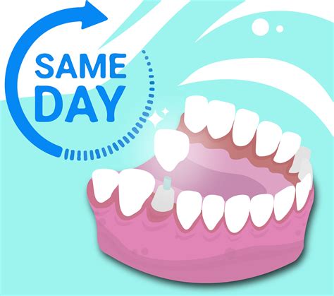 Same Day Dental Crowns .